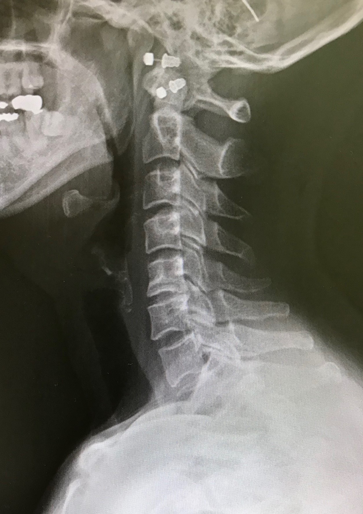 症例A 6か月使用後の頸椎X線