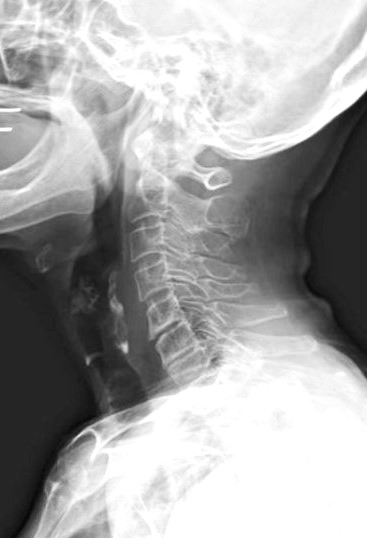 症例B 6か月使用後の頸椎X線