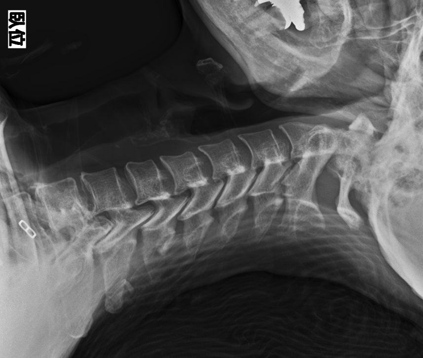 通常の枕で仰臥位の頸椎X線